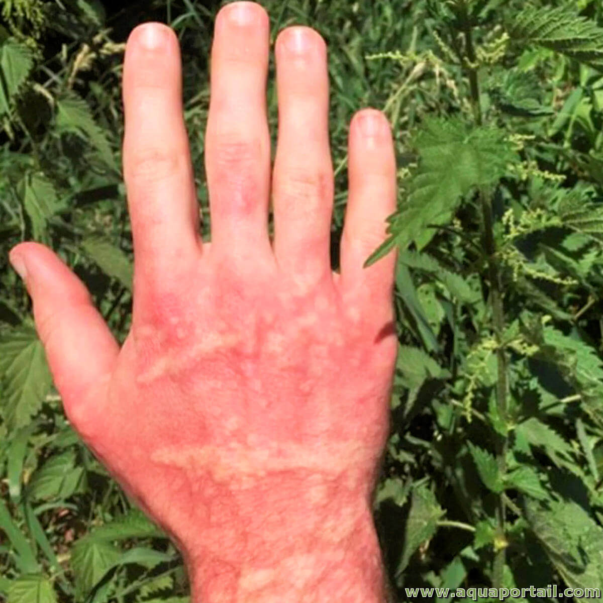 Allergie aux orties : mythe ou réalité ?