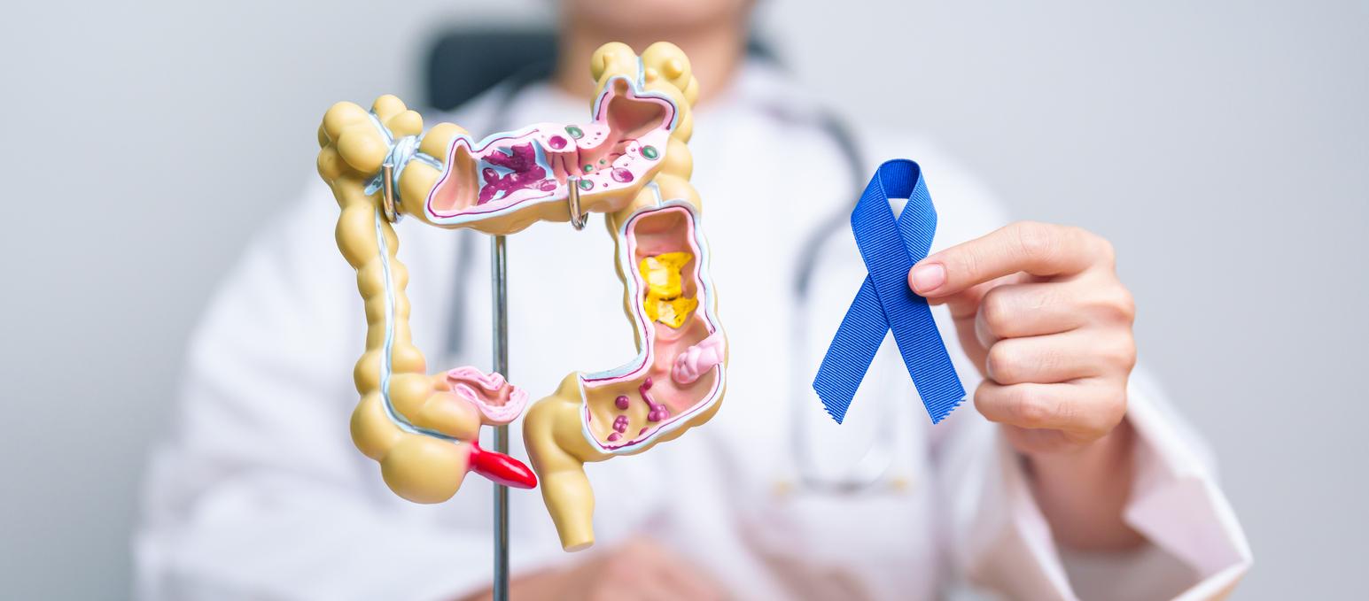 Cancer colorectal chez les jeunes : comprendre l&rsquo;augmentation inquiétante et ses facteurs déclencheurs