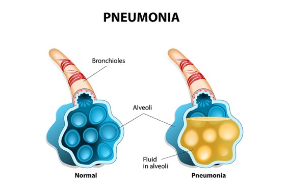 La pneumonie : un mal contagieux ou non ?